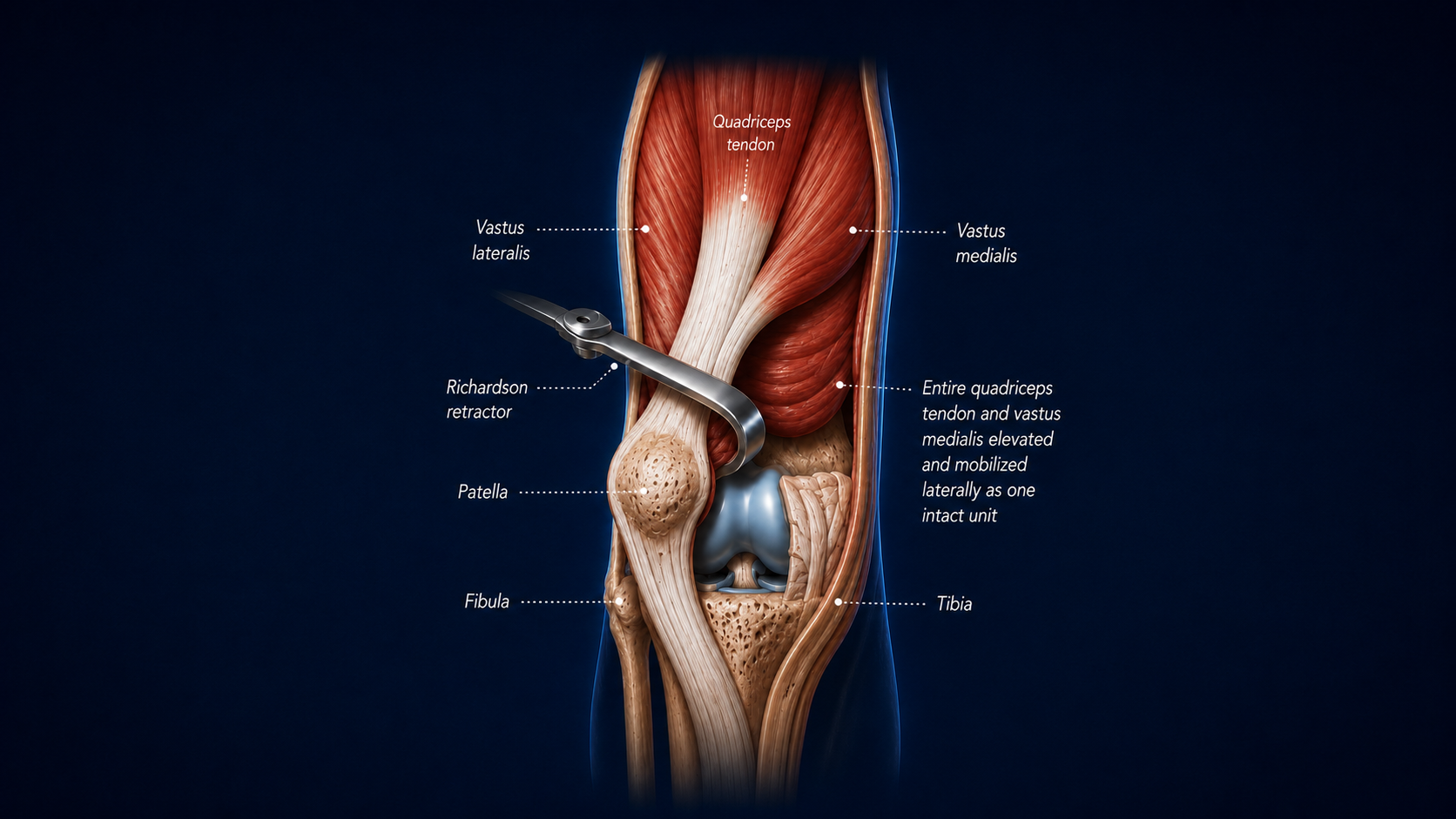 Muscle/Tendon Sparing Subvastus Total Knee Replacement